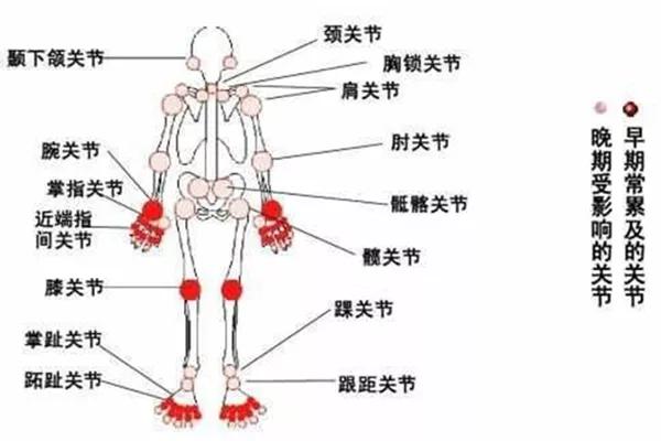 类风湿关节炎患者多久复查比较合适?