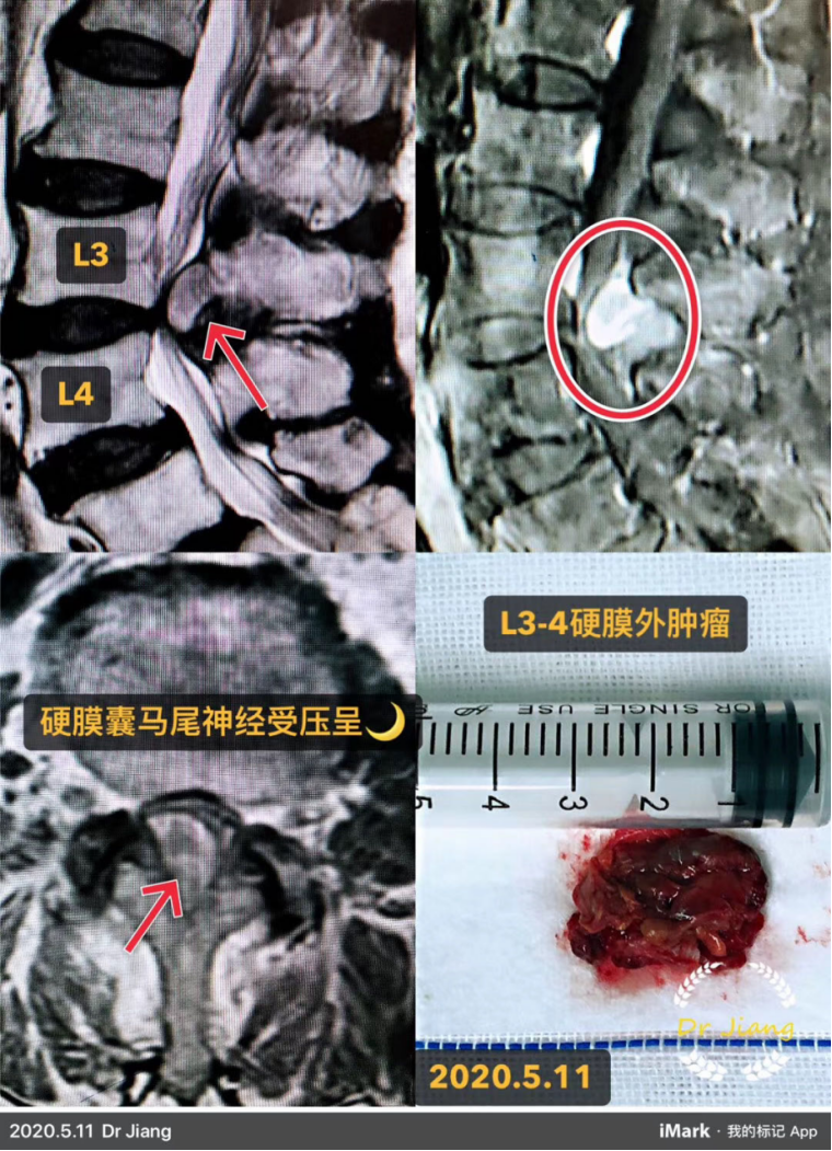警惕不一样的腰腿痛—椎管内常见肿瘤(原创)