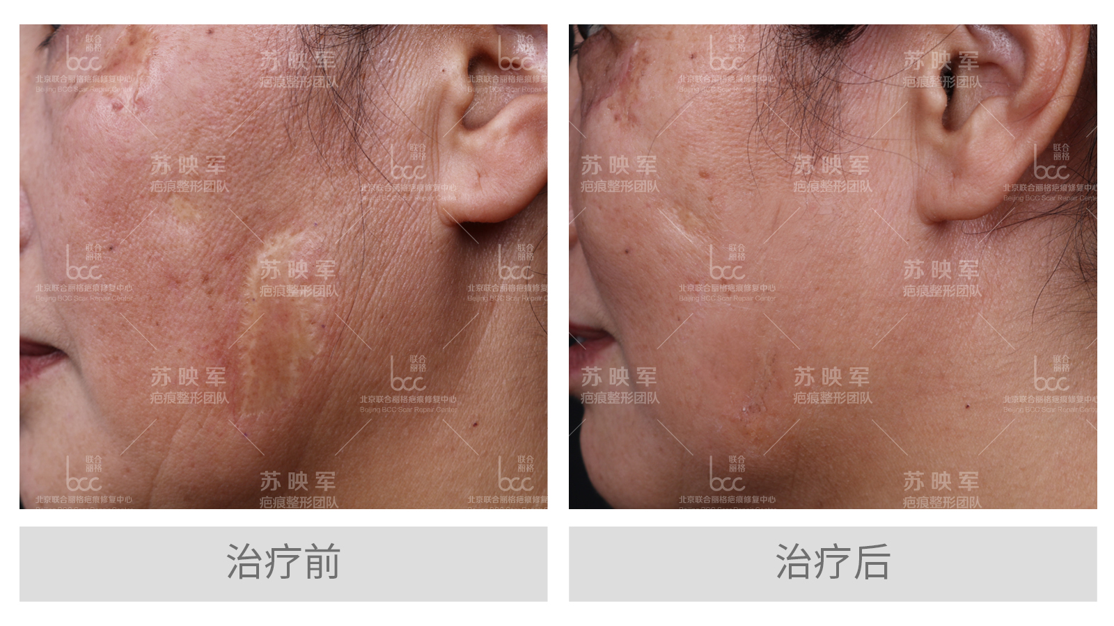 面积等情况,伤烫伤疤痕可采取激光手段,手术切除,植皮,皮肤扩张器