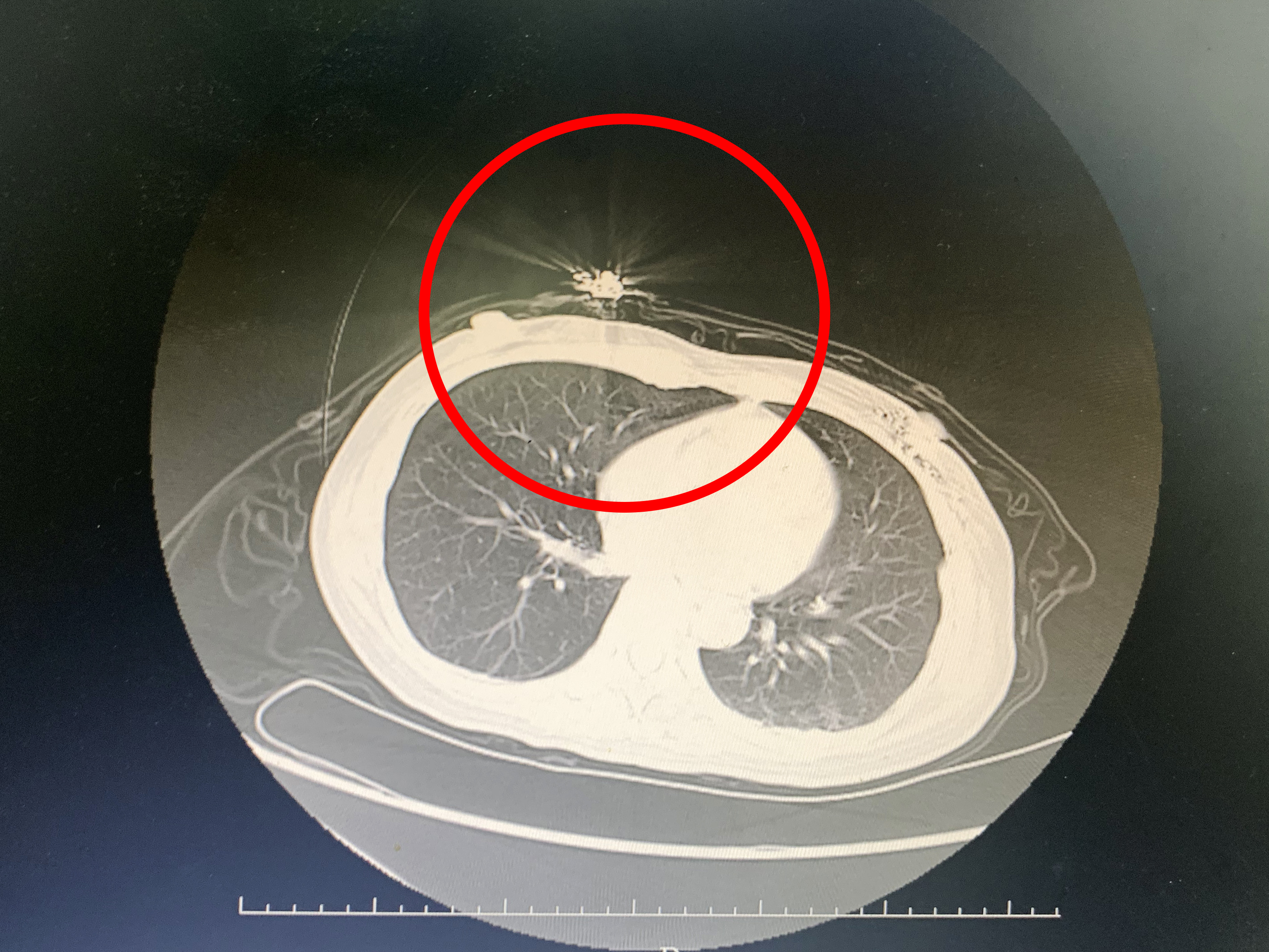乳腺癌晚期并多发性骨转移,是这里给了我第二次生命