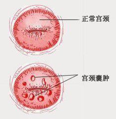 子宫囊肿,没啥大不了!