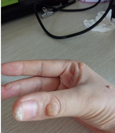 瘊子要怎么治疗?