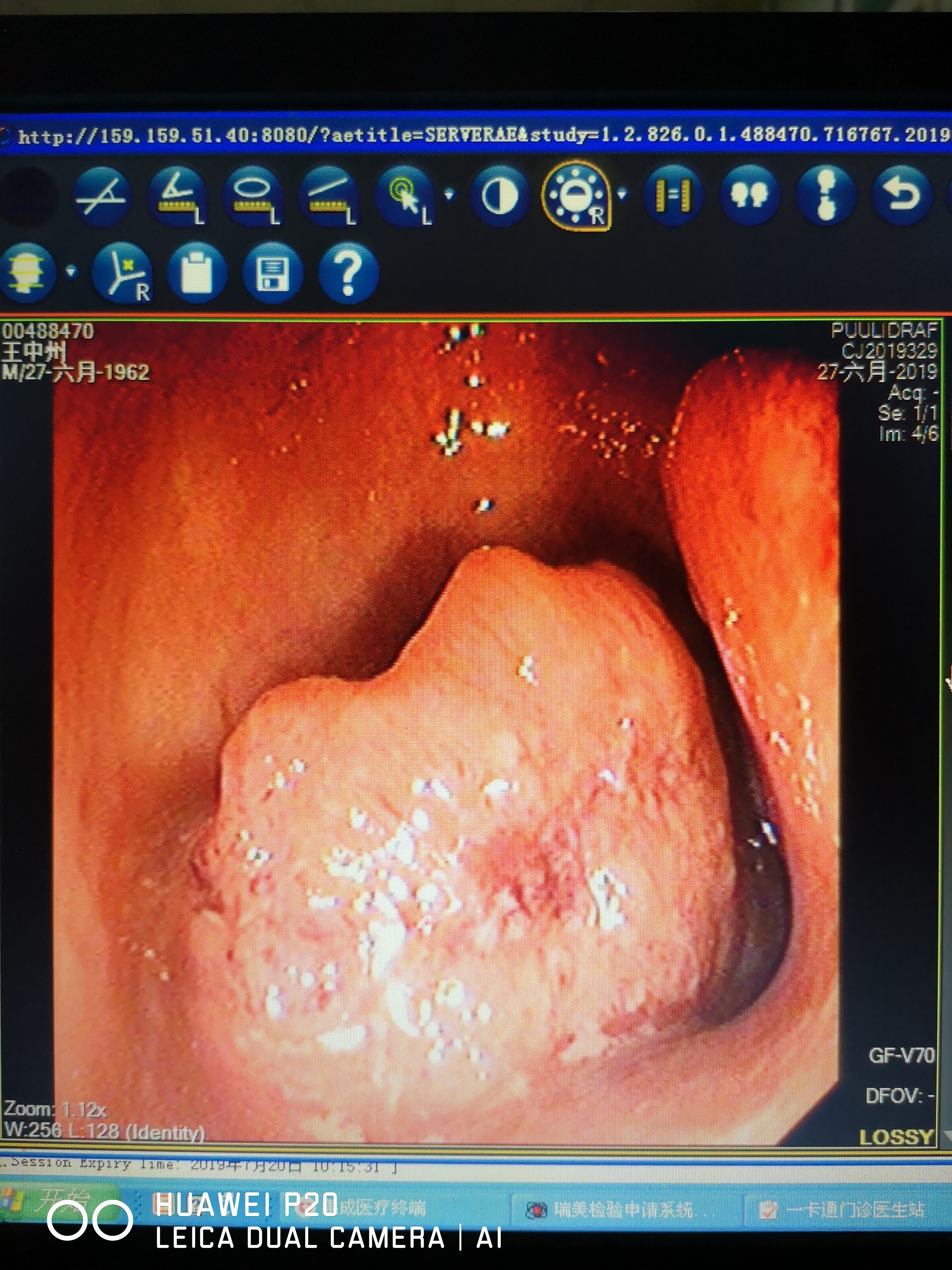 那么直肠癌有哪些症状呢?