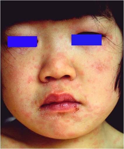 伴有发热的皮肤病二发疹发热性传染病