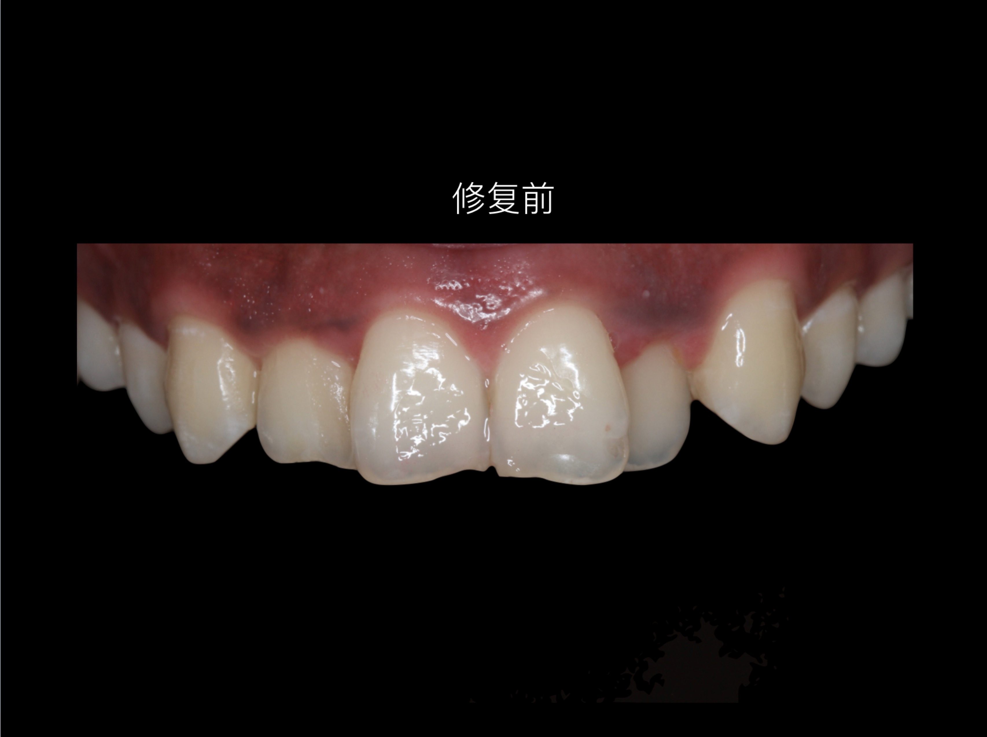 美学修复病例欣赏