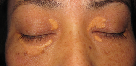 睑黄瘤是否为健康的黄色警告