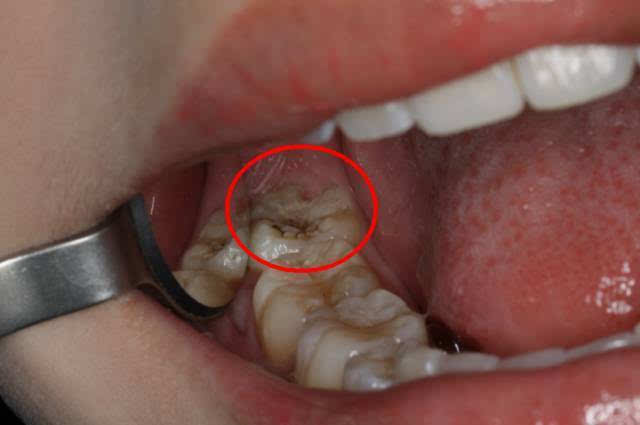 智齿长牙龈侧面上图片