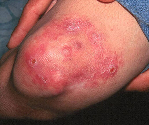 梅毒脓包症状的照片图片
