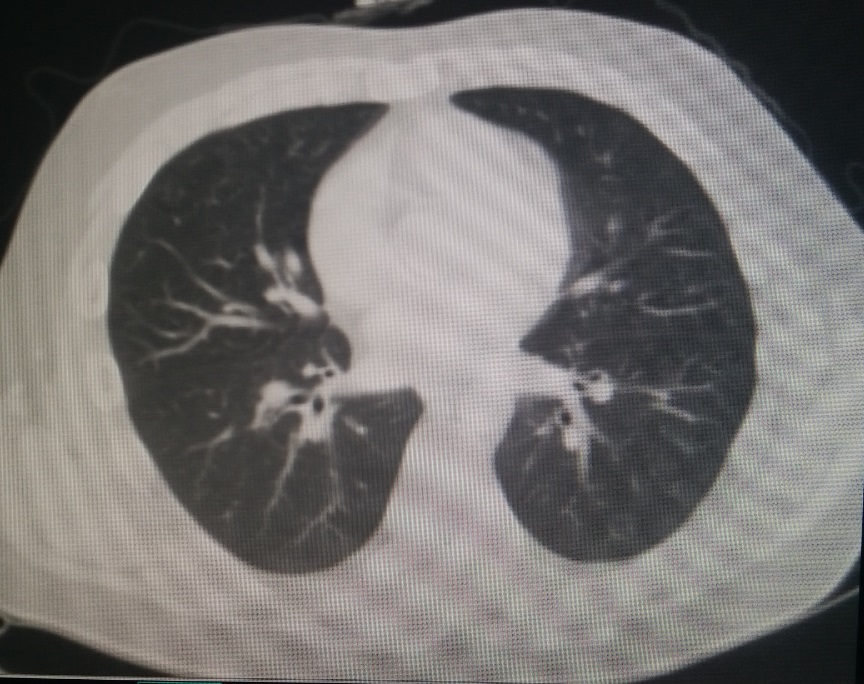 今天上午:重度桶状胸的"小手术"