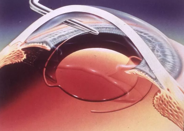 (icl人工晶体植入术)患者在接受晶体摘除手术后,眼睛就如同相机没有了