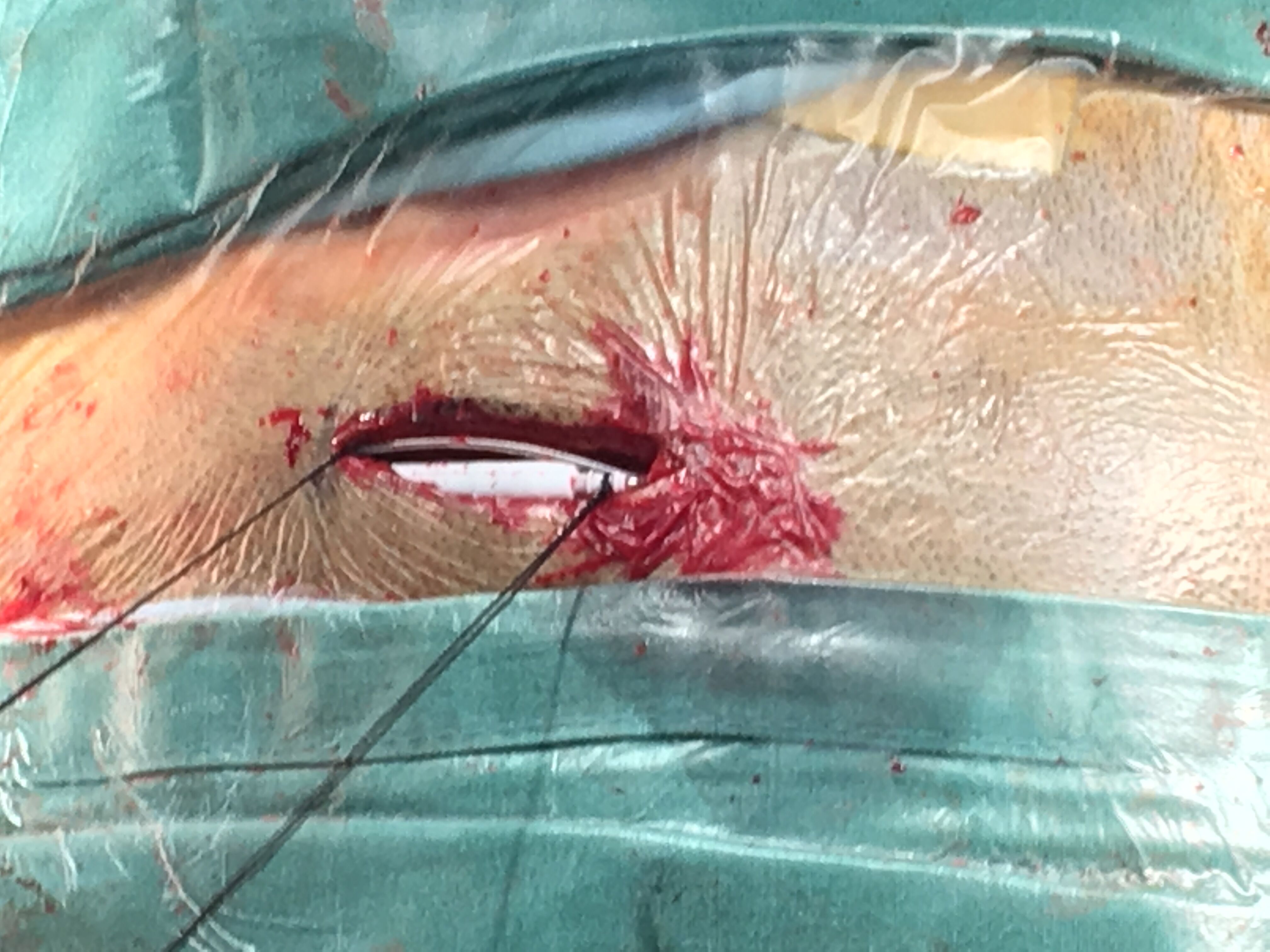 帕金森病患者dbs手术治疗,如何选对医院及专家?