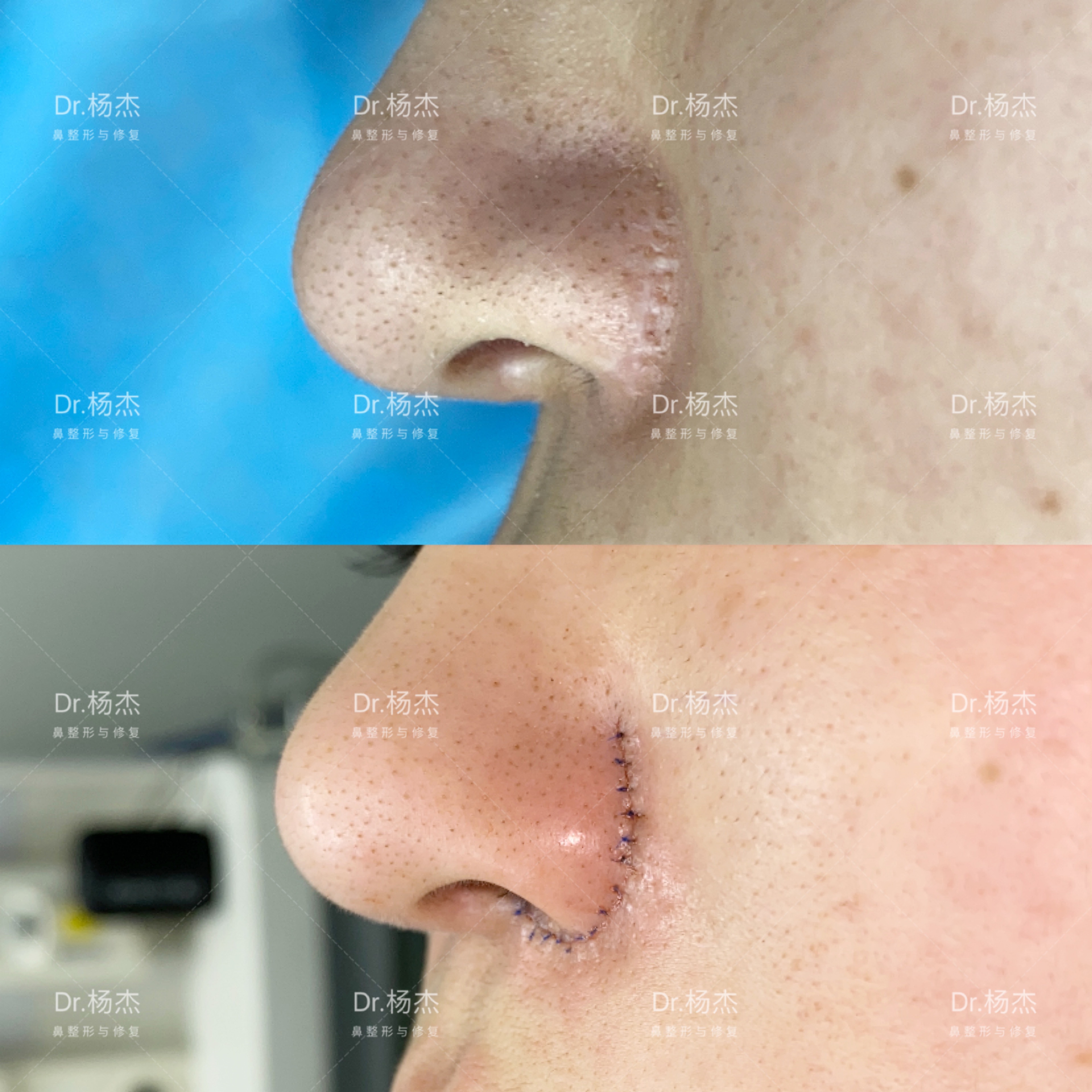 鼻槛修复+鼻翼内外疤痕修＋ADM鼻基底凹陷填充 - 知乎