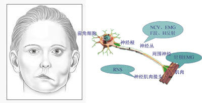 cn面肌痉挛(hemifacialspasm,hfs),又称面肌抽搐或半侧颜面痉挛,是指