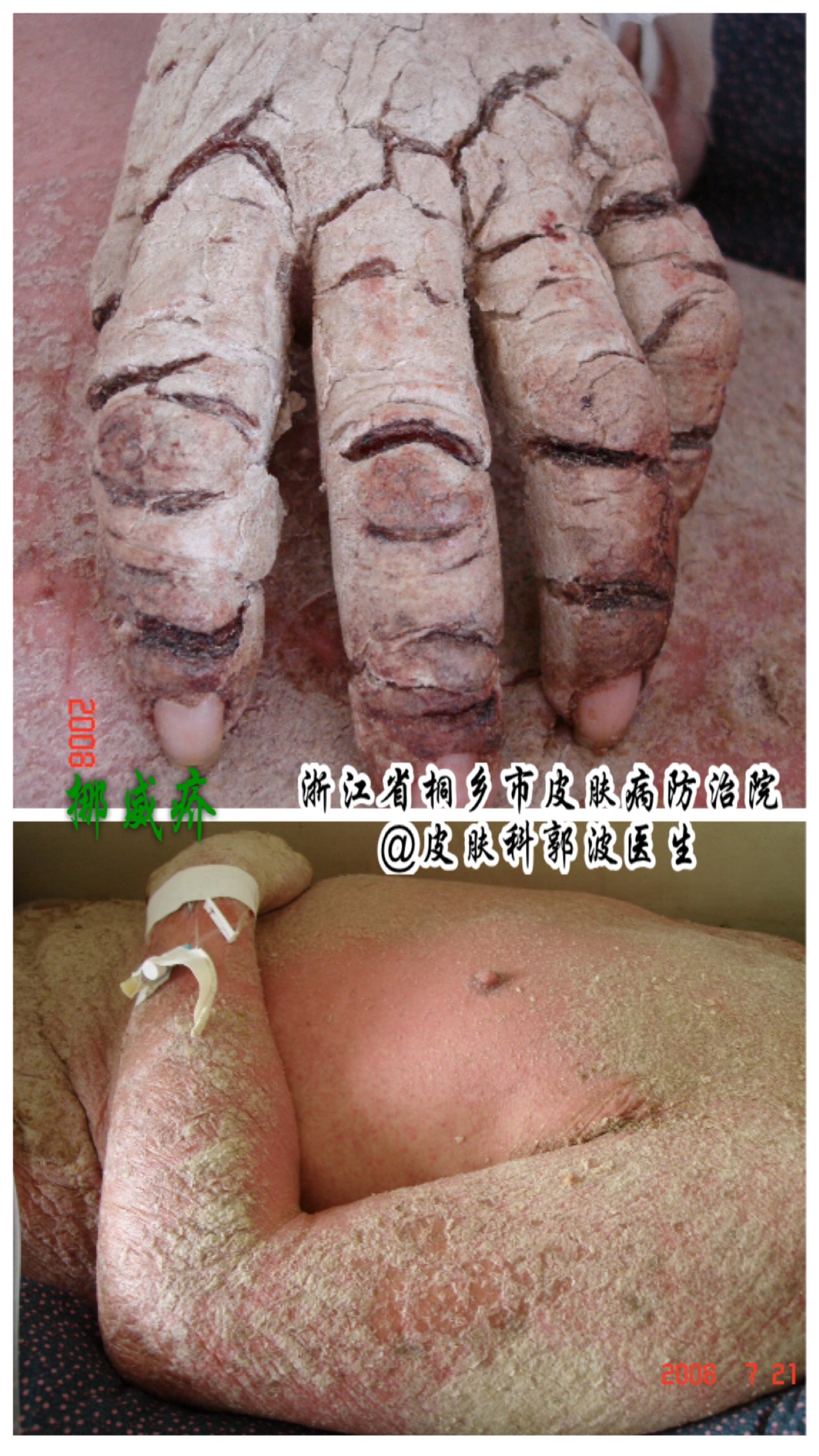 疥虫感染睾丸的图片图片