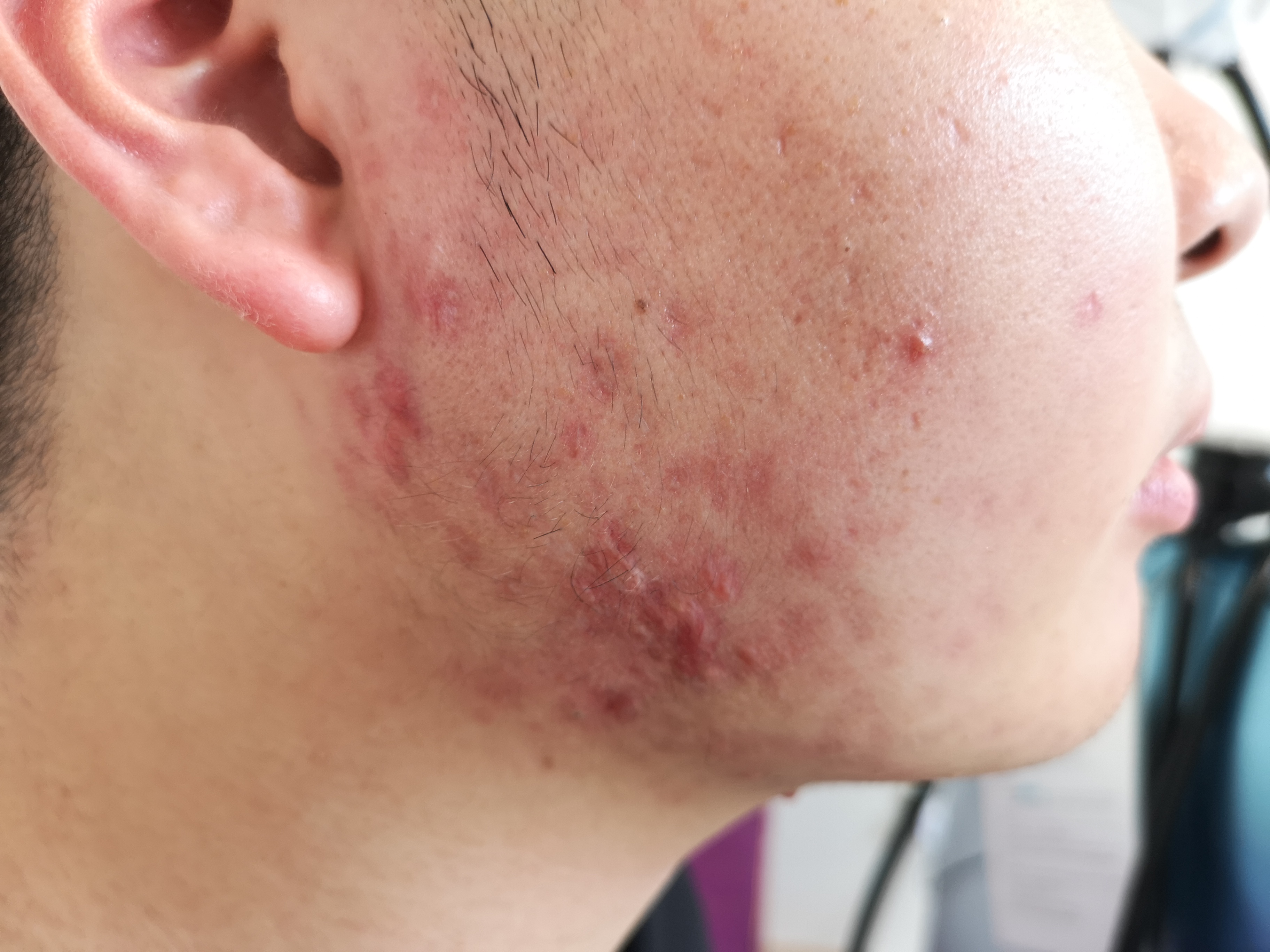 痘痘(痤疮)虽然让许多人烦恼不已,但依然有不少人治疗上过于轻视,总