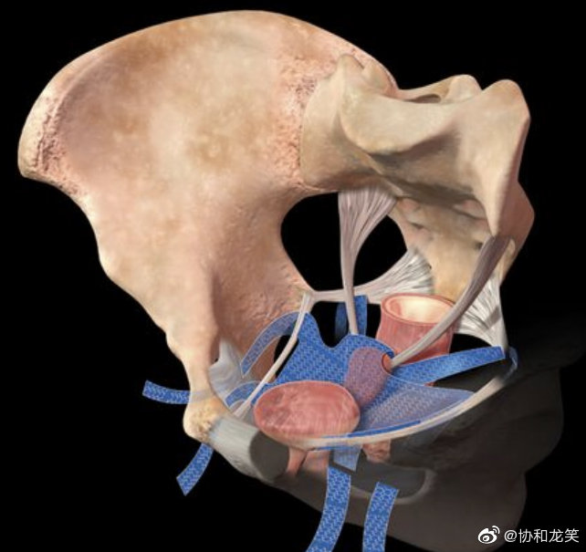 除了上面的方法外还有阴道前壁修补术,mmk手术等方法,是目前应用较少.