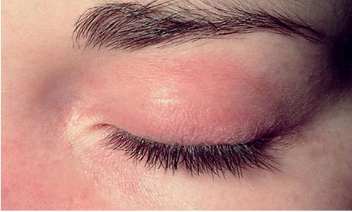 水晶葡萄眼睑:上覆皮肤不规则和苔藓化皮肌炎的披肩征样皮疹:点状色素