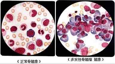多发性骨髓瘤血片图片