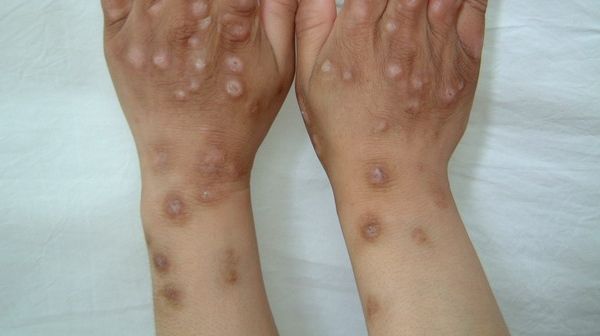 中医如何治疗结节性痒疹?