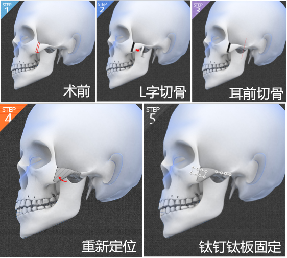 【颧骨颧弓手术过程示意图】我们先来简单了解一下颧骨颧弓手术因为