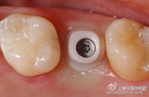 粘结固位,使用的是nobel公司procera氧化锆全瓷基台.