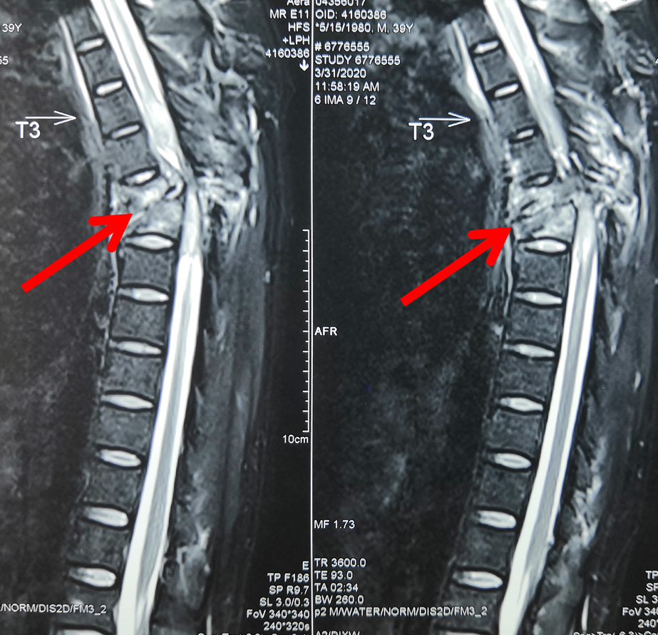 39岁的安先生不慎被重物砸伤,导致全身多发伤,胸椎骨折导致他当场瘫痪