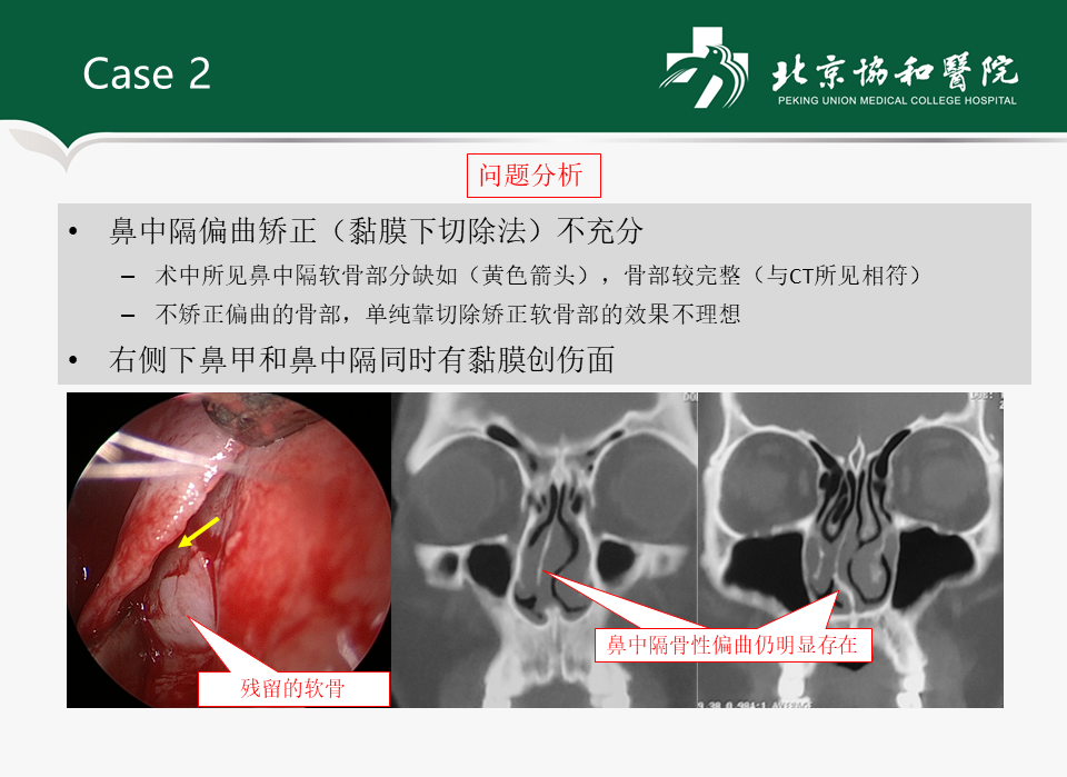 不得轉載2020-02-20 23:3619,086人已讀鼻中隔偏曲查看更多鼻科乾貨