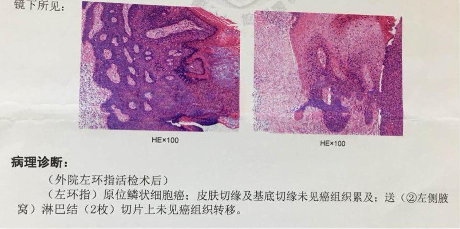 关于皮肤鳞癌,恶性黑色素瘤,皮肤痣,指甲痣的区别您知道吗?