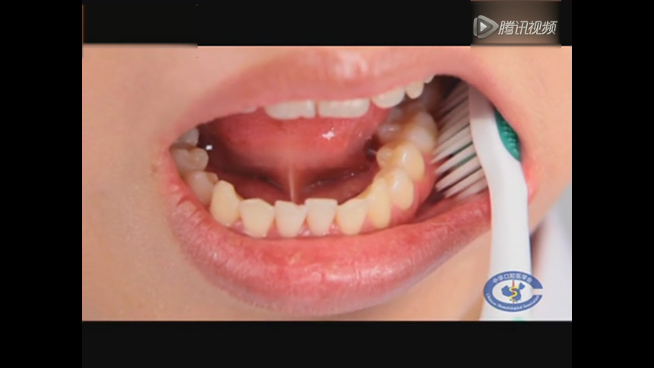 2)用同样的方法刷后牙舌颚侧.