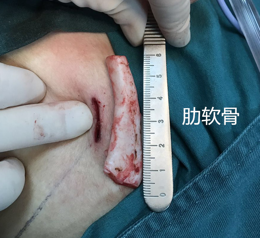 取肋软骨选择的是第6,7根肋骨之间的软骨(注意:是软骨,不是肋骨),软骨
