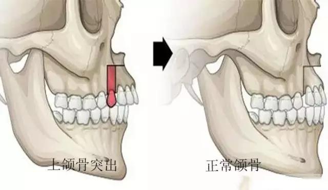 上颌骨垂直向发育过度,也就是上颌骨突出,上唇软组织会显得相对不足