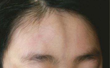 局限性硬皮病| 疾病复杂治疗难?是时候改变你的关注点了