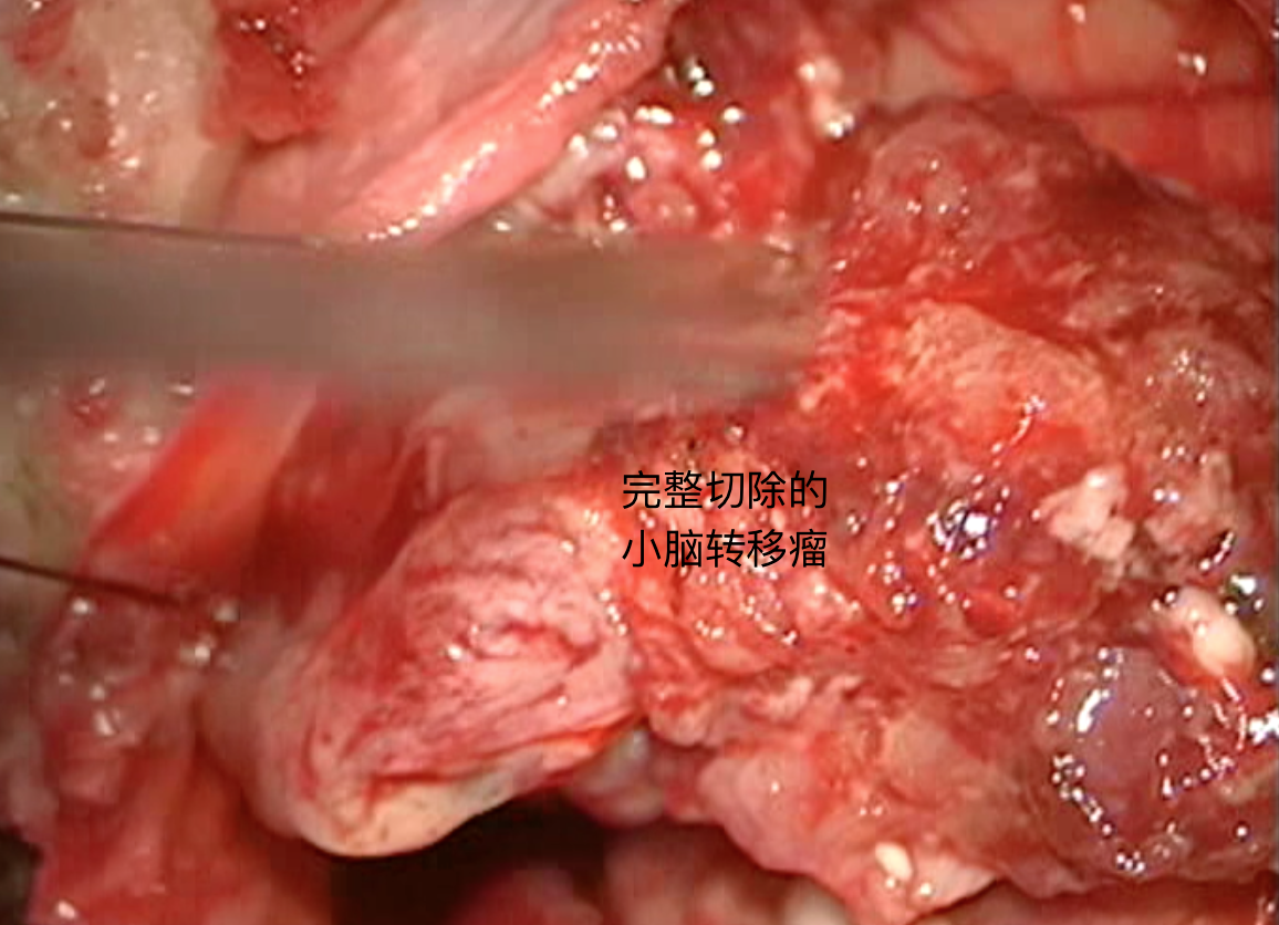 高龄患者小脑转移瘤手术治疗