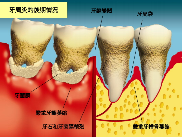 牙周病原来是这样的