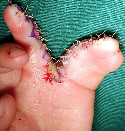 手指连在一起生长肿么破