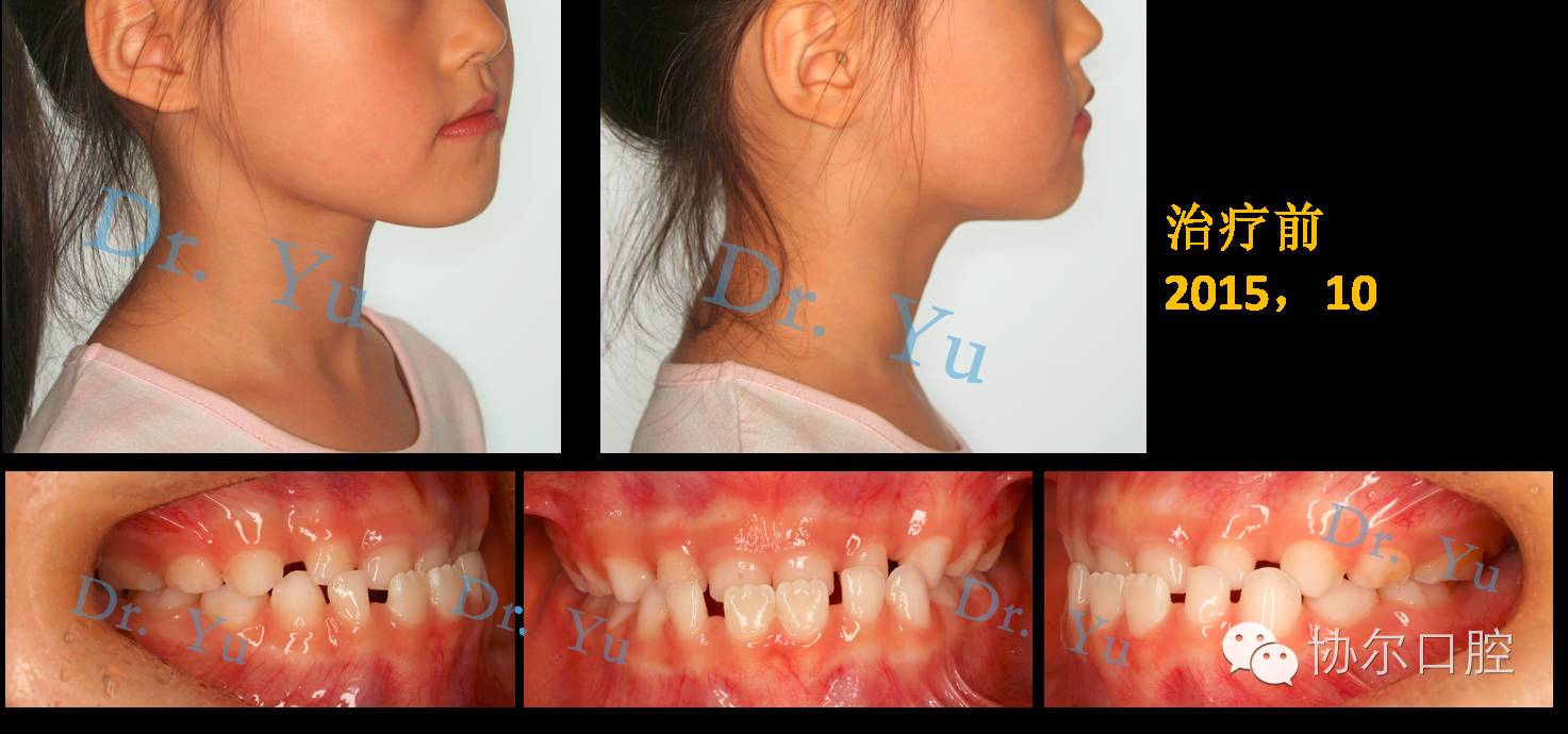 对于不良习惯引起的肌肉功能异常所导致的颜面,牙齿发育异常,针对性地