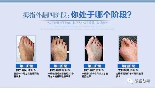 什么是拇外翻?该怎么办呢?-朱伟主任医师-爱问医生