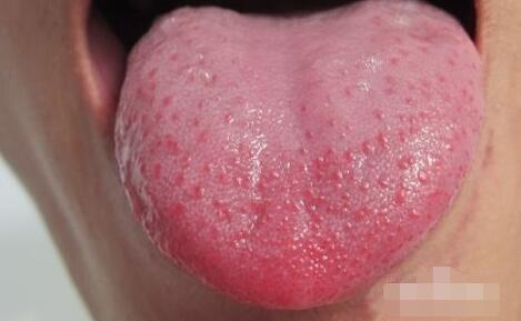 舌苔芒刺图片