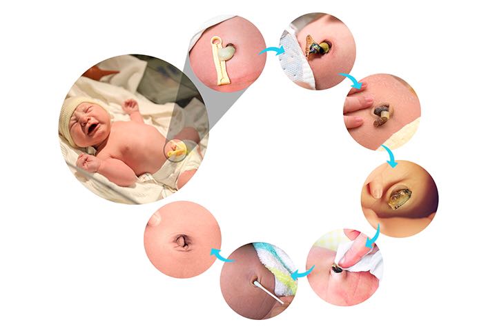 宝宝脐带脱落过程图图片