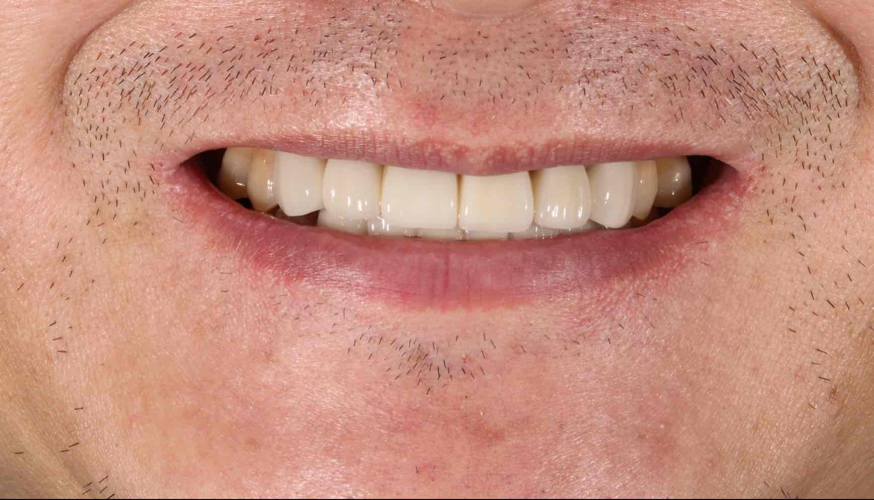 前牙区缺失牙修复对比案例