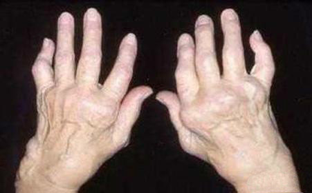 75岁的老奶奶手指扭曲变形,注意这六点,远离类风湿关节炎!