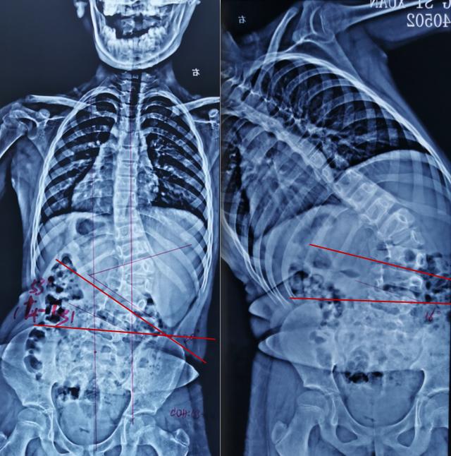 手術治療先天性脊柱側凸畸形脊髓縱裂病例分享