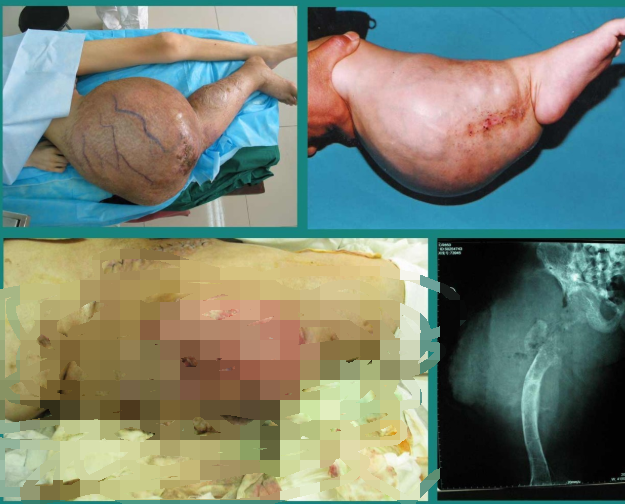 尤文肉瘤早期症状图片图片