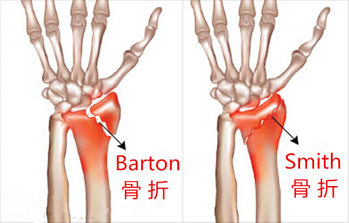 枪刺样和银叉样畸形图片