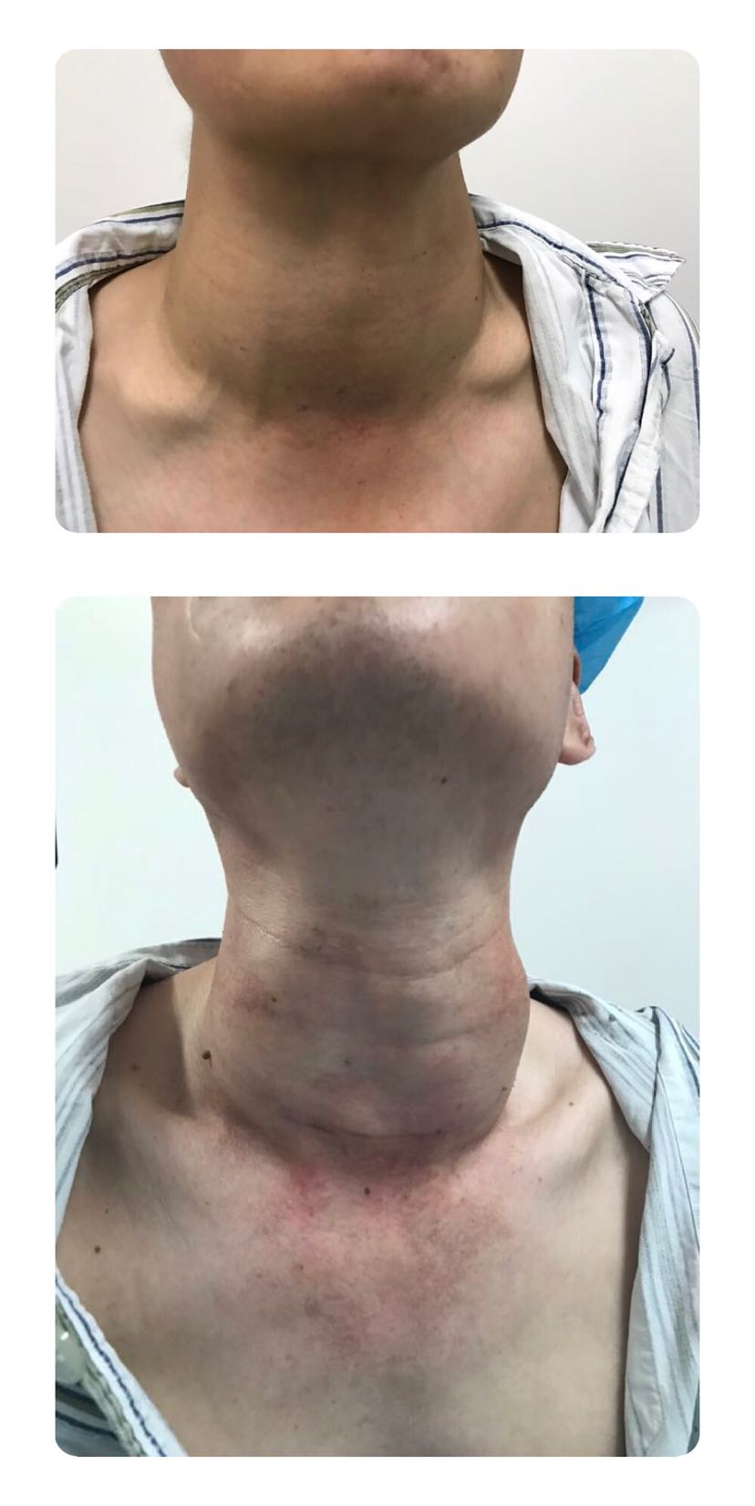 甲亢究竟是一种什么样的病?