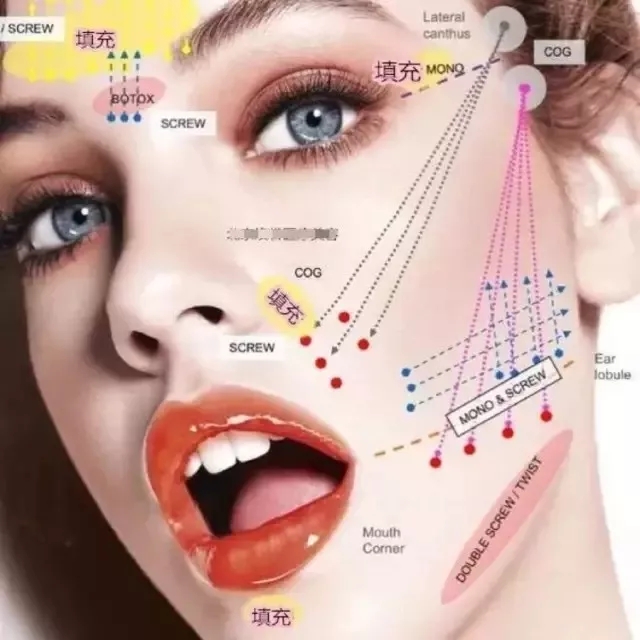 线雕提升:提上去30岁,放下来50岁!你还在等什么?