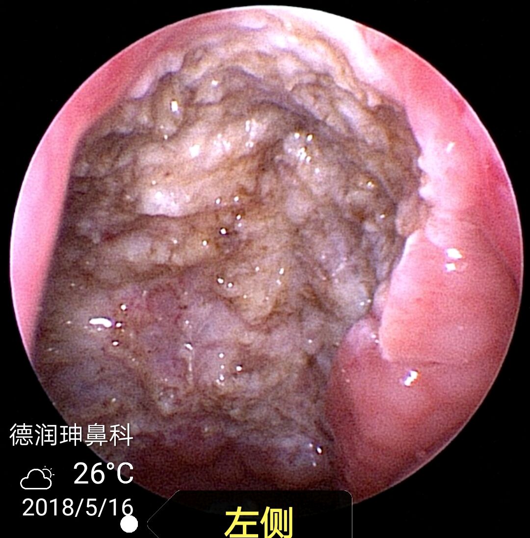 扁桃体脓栓图片图片