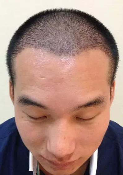 案例分享:五级脱发半年蜕变成这样.