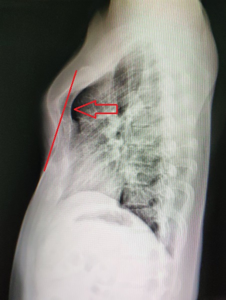 壁呈"s"形改变,以突起为主要特征,凹陷程度不深,突出以胸骨角处最明显