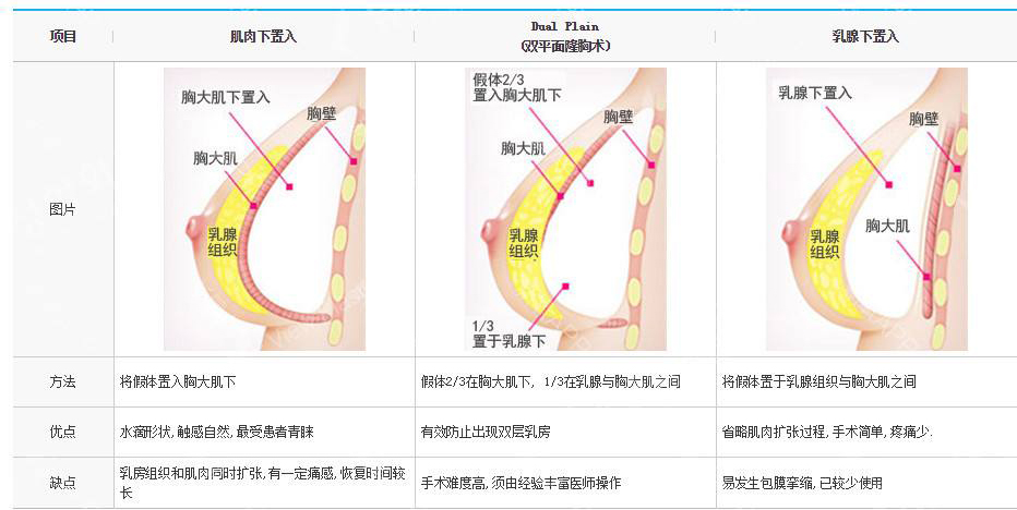 假体植入胸腔位置应该如何选择?